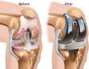 Warning Knee Replacement Surgery