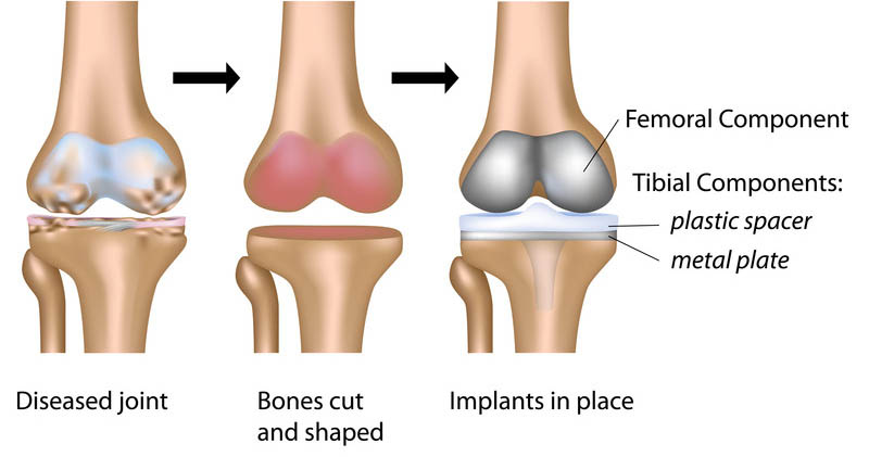 Warning Signs That Suggests You Need Knee Replacement Surgery